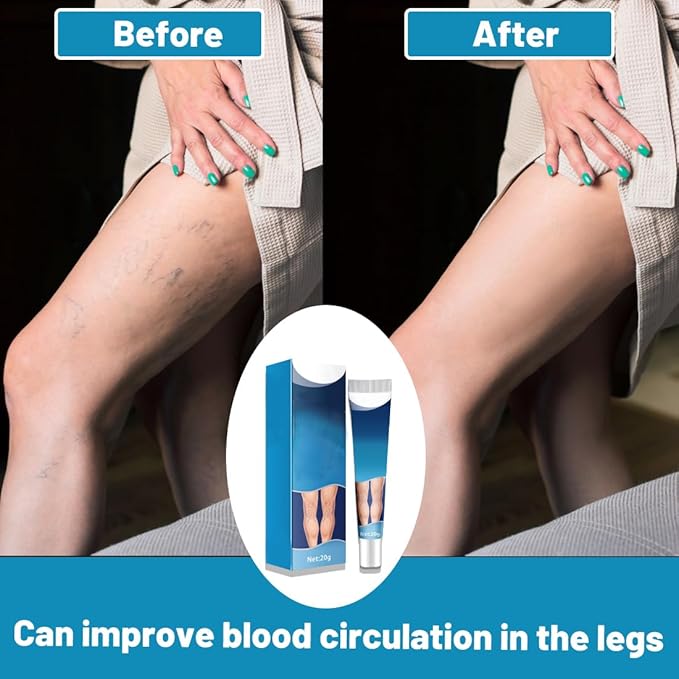 Crema para Varices con ENVÍO GRATIS ⭐⭐⭐⭐⭐