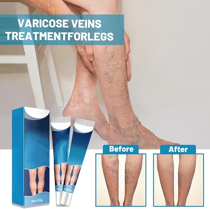 Crema para Varices con ENVÍO GRATIS ⭐⭐⭐⭐⭐