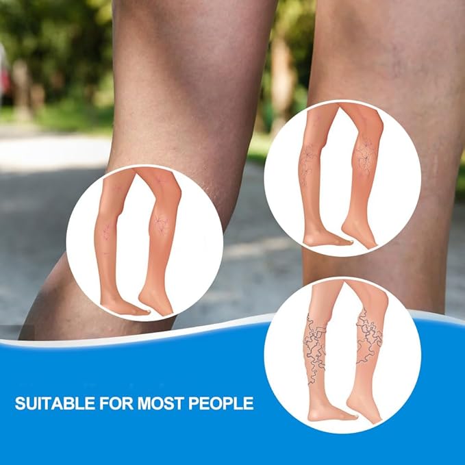 Crema para Varices con ENVÍO GRATIS ⭐⭐⭐⭐⭐