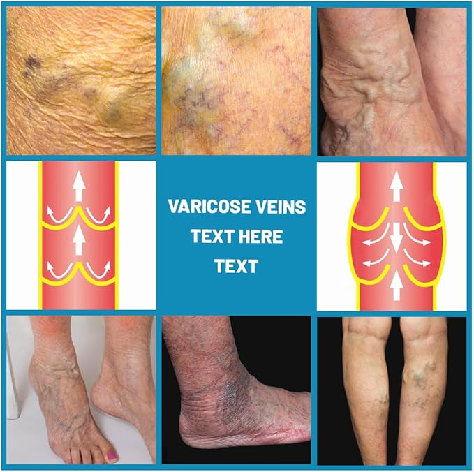 Crema para Varices con ENVÍO GRATIS ⭐⭐⭐⭐⭐