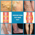 Crema para Varices con ENVÍO GRATIS ⭐⭐⭐⭐⭐