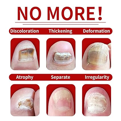 Tratamiento hongos uñas con  ENVÍO GRATIS⭐️ ⭐️ ⭐️ ⭐️ ⭐️