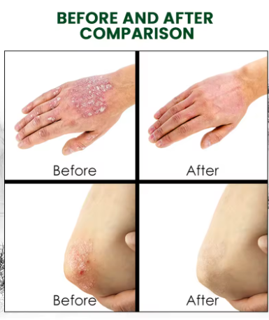 CREMA PSORIASIS UNGENTO con ENVÍO GRATIS ⭐️⭐️⭐️⭐️⭐️