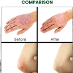 CREMA PSORIASIS UNGENTO con ENVÍO GRATIS ⭐️⭐️⭐️⭐️⭐️